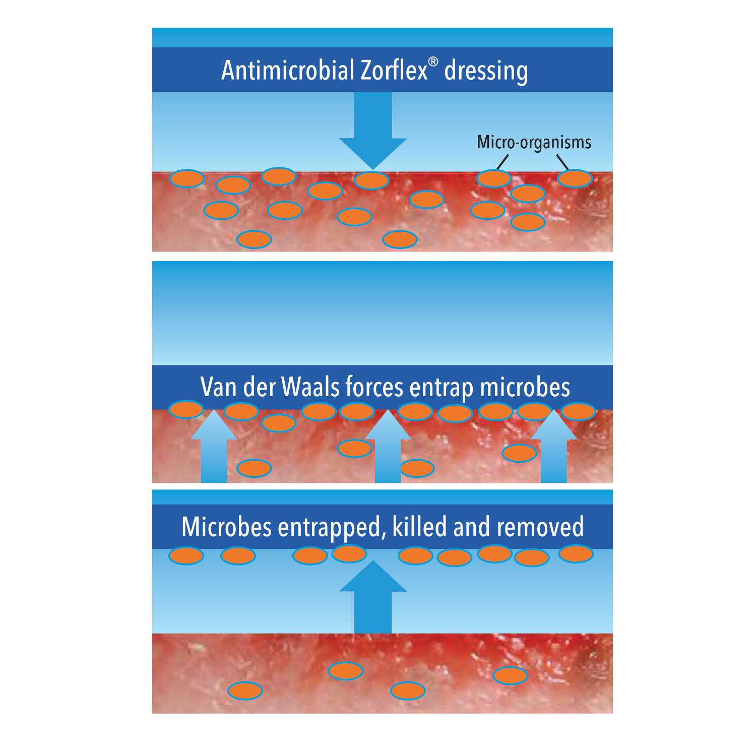 Zorflex® Antimicrobial Carbon Cloth Dressings – Novagran