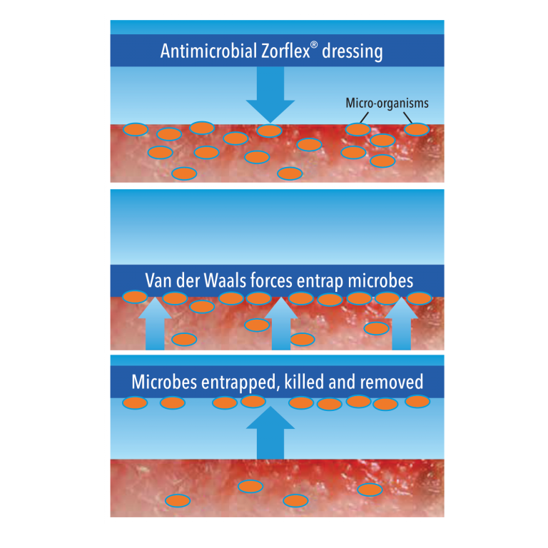Zorflex® Carbon Cloth Dressings – NovaGran